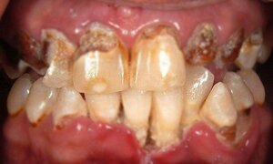 Những người dùng ma túy đá như Châu Việt Cường có biểu hiện nào để nhận biết?