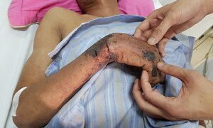 Món ăn ưa thích khiến 9 bệnh nhân nứt thịt, hoại tử da
