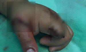 Bé trai 3 tuổi đứt lìa hai ngón tay vì xích xe máy