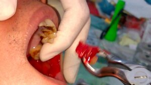 Răng số 8 là gì, răng số 8 mọc lệch có nên nhổ không?