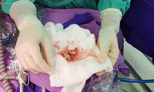 Đau bụng kèm sốt, bé gái 3 tuổi mắc bệnh hiếm gặp