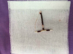 Vòng tránh thai đi lạc trong ổ bụng người phụ nữ