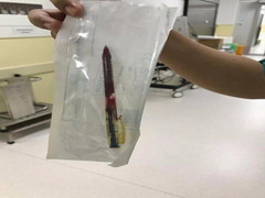 Tội nghiệp bé gái 4 tuổi vấp ngã bị bút bi đâm thấu ngực