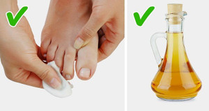 Những cách tự nhiên chữa móng chân mọc lệch đâm vào da thịt