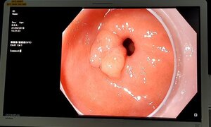 Xem tiến sĩ Nhật trình diễn dò cắt khối ung thư trong dạ dày