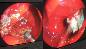 Chảy dịch trắng như sữa, nam thanh niên tá hỏa vì 'mọc nấm' trong mũi