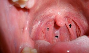 Ung thư vòm họng là gì, bệnh chết người rất nhanh này có chữa được không?