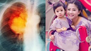 Ung thư phổi là gì, ung thư phổi có chữa được không?