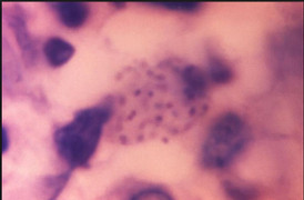 Cô gái nhiễm vi khuẩn ăn thịt người qua đường tình dục