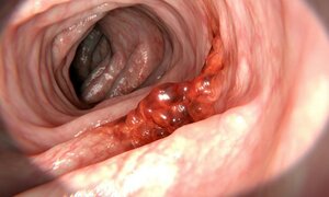 5 thói quen ăn uống người Việt nào cũng mắc dễ gây ung thư dạ dày