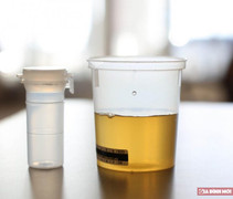 Người đàn ông mắc bệnh lạ, bác sĩ phải lọc nước tiểu để lấy tinh trùng