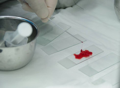 Những dấu hiệu của bệnh ung thư buồng trứng