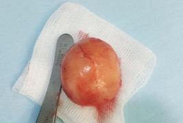 Người đàn ông 48 năm chung sống cùng 3 tinh hoàn