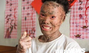 Bí ẩn bức tranh làm từ da của anh chàng mắc bệnh hiếm