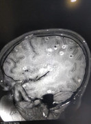 Trứng sán từ dạ dày 'chạy' lên não theo đường máu, cô bé có 100 trứng sán dây trong đầu