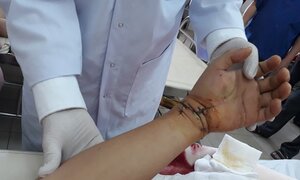 Bảo quản trong đá lạnh, bàn tay trái bị đứt lìa được ghép nối thành công