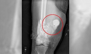 Bác sĩ nhờ đội phá bom gỡ pháo hoa chưa nổ mắc kẹt trong đùi bệnh nhân