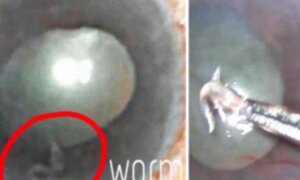 Rùng rợn hình ảnh ký sinh trùng sống trong mắt người phụ nữ Ấn Độ