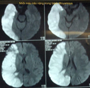 Hai trẻ bị đau đầu bất thường mắc bệnh máu não hiếm gặp