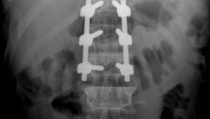 Người đàn ông ngã từ giàn giáo cao 3m vỡ đốt sống thắt lưng