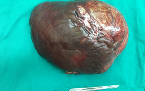 Bệnh nhân ở Nam Định mắc bệnh lý hiếm gặp trên thế giới