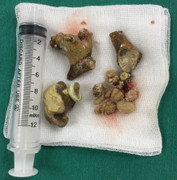 Viên sỏi to như củ gừng nằm trong thận nam bệnh nhân suốt 3 năm