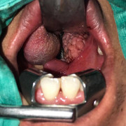 Khủng khiếp amidal sần sùi, nổi cục như chùm nho chèn kín đường thở