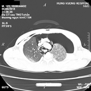 Cái kết đắng với thanh niên 18 tuổi uống rượu say, ngã đập ngực tràn dịch phổi