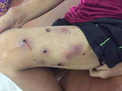 Rùng mình bé gái 12 tuổi toàn thân đầy mụn mưng mủ, ứa máu vì mắc bệnh này