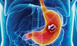 6 dấu hiệu không hề đau đớn nhưng cảnh báo ung thư dạ dày