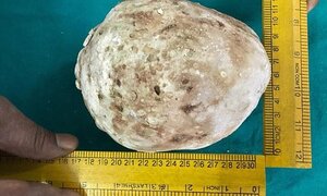 Bác sỹ vật lộn hàng tiếng đồng hồ lấy viên sỏi thận to như quả bưởi