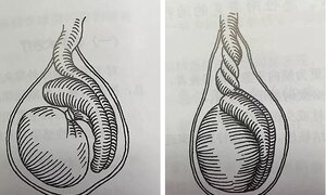 Xoắn tinh hoàn khi ngủ, cẩn thận mất cơ hội làm bố