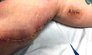 Vi khuẩn ăn thịt người 'đục' lỗ to bằng nắm tay trên chân thiếu nữ
