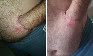 Khó tin: Bàn tay bị cụt, người đàn ông rạch da khâu luôn vào bụng