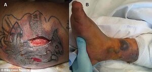 Xăm mình mới 5 ngày, người đàn ông chết do bị vi khuẩn ăn thịt người trên biển