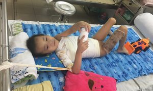 Điều trị thành công cho cháu bé chữa thuốc đông khiến cánh tay bị dính vào sườn