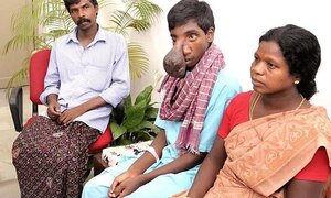 Cậu bé 'quái nhân' với bươu não to như quả bóng ở giữa mặt