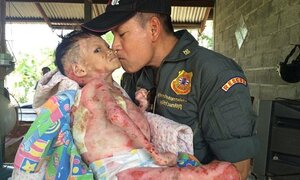 Cô bé mắc căn bệnh ‘da bướm’ hiếm gặp, 50.000 người mới có một người mắc