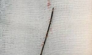 Hy hữu: Phát hiện cây kim 4 cm trong lồng ngực bé gái 3 tuổi, do bị ngã từ 2 năm trước