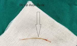 Ăn cá hóc xương, cụ già 72 tuổi bị thủng ruột