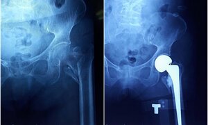Cụ bà 102 tuổi được thay khớp háng nhân tạo thành công