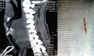 Hóc xương cá, người đàn ông ở Quảng Trị suýt mất mạng