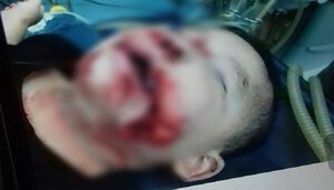 Chơi đùa với chó becgie, bé trai 21 tháng tuổi bị cắn rách má
