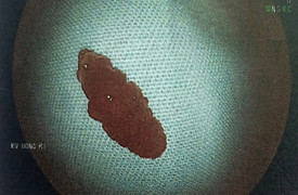 Nội soi dạ dày bệnh nhân, bác sĩ phát hiện 'bắt sống' một con sán lá gan lớn