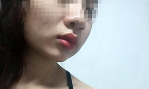 Thiếu nữ xinh đẹp bỗng sưng phù mặt, nổi hạch vì làm má lúm đồng tiền tại nhà
