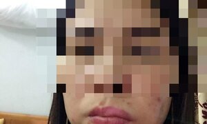 Hà Nội: Làm má lúm đồng tiền, mặt méo xệch đáng sợ
