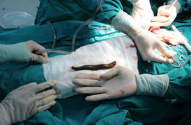 Rợn người xem cảnh gắp đỉa ra khỏi mũi bệnh nhân