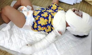 Thương tâm bé gái 9 tháng tuổi ngã vào bếp lửa khiến mặt biến dạng