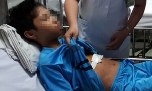 Mổ cấp cứu cho bé trai bị kim đâm trúng vào lồng ngực