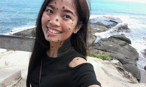 Cô gái có hàng trăm nốt ruồi giăng kín người vẫn tự tin đi thi Hoa hậu hoàn vũ